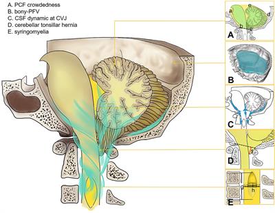 Potential association among posterior fossa bony volume and crowdedness, tonsillar hernia, syringomyelia, and CSF dynamics at the craniocervical junction in Chiari malformation type I